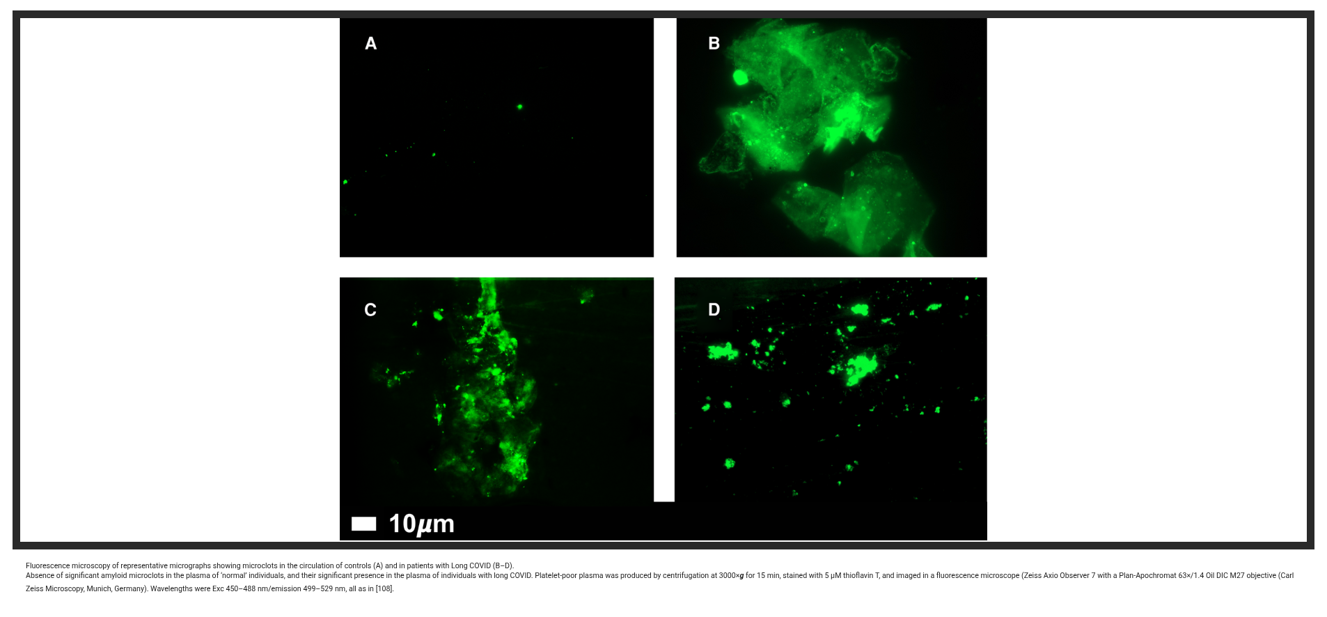 Fluorescence microscopy showing fibrin amyloid microclots in Long COVID patient samples with thioflavin T staining