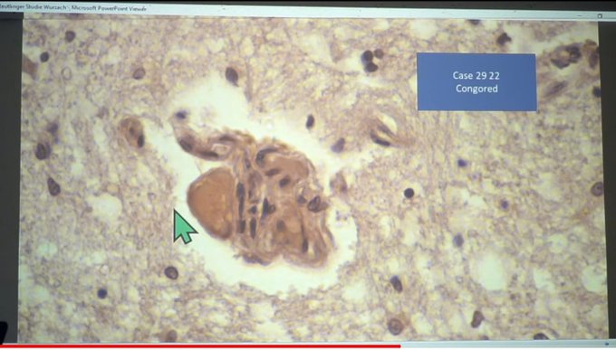 Diagram showing amyloid fibrin formation mechanism
